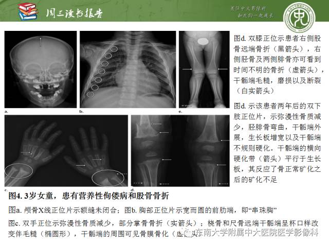 【PPT】代谢性骨病影像学表现【RG精选】