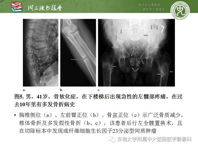 【PPT】代谢性骨病影像学表现【RG精选】