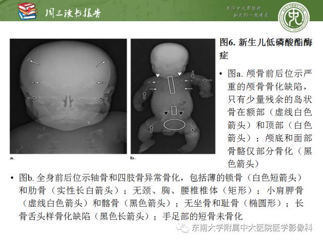 【PPT】代谢性骨病影像学表现【RG精选】
