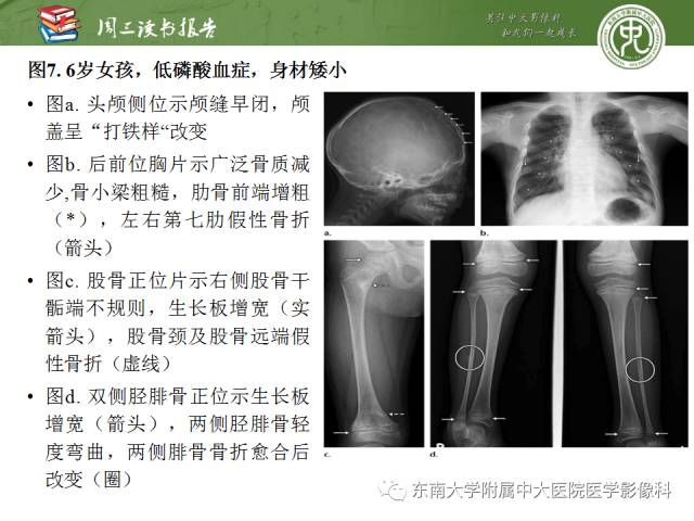 【PPT】代谢性骨病影像学表现【RG精选】