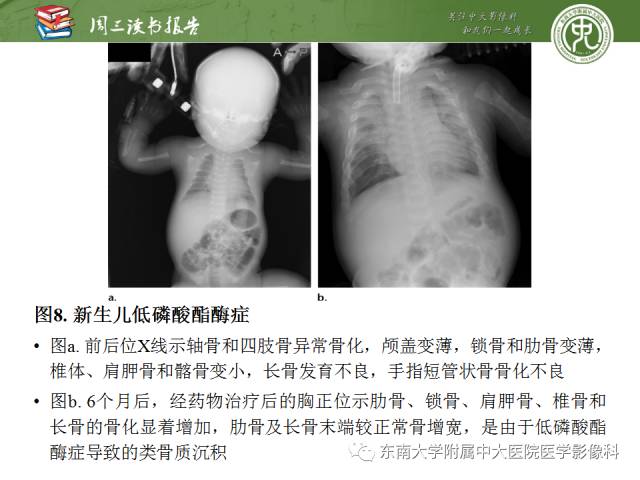 【PPT】代谢性骨病影像学表现【RG精选】