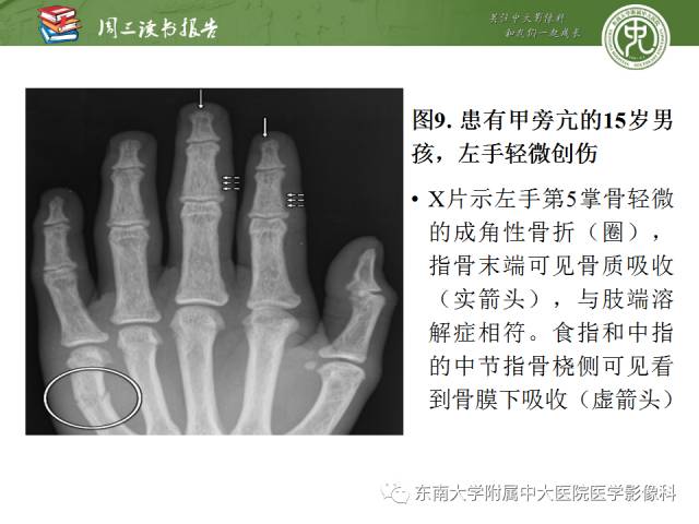 【PPT】代谢性骨病影像学表现【RG精选】