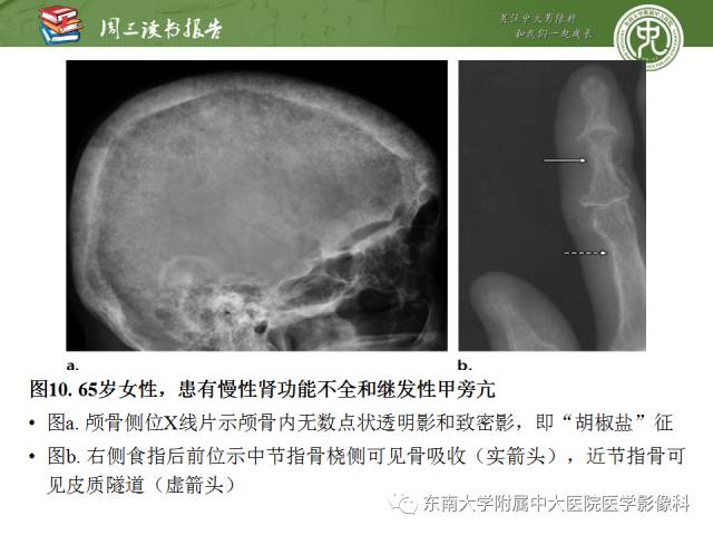 【PPT】代谢性骨病影像学表现【RG精选】