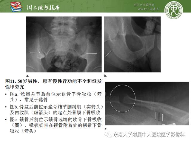 【PPT】代谢性骨病影像学表现【RG精选】