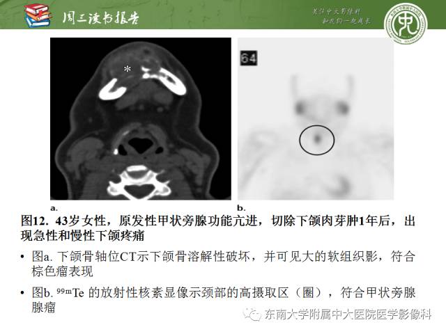 【PPT】代谢性骨病影像学表现【RG精选】
