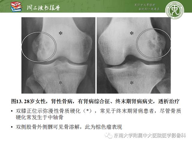 【PPT】代谢性骨病影像学表现【RG精选】