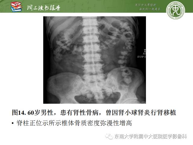 【PPT】代谢性骨病影像学表现【RG精选】