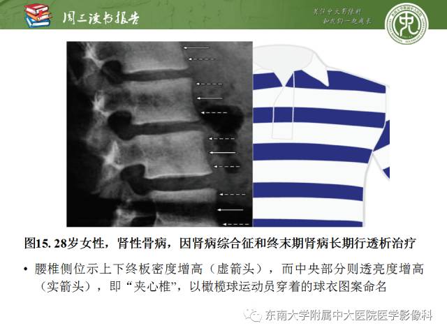 【PPT】代谢性骨病影像学表现【RG精选】