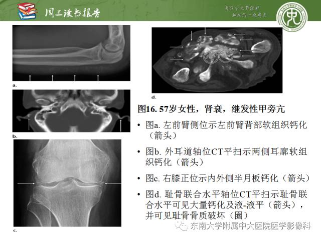 【PPT】代谢性骨病影像学表现【RG精选】