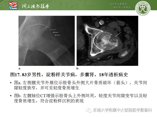 【PPT】代谢性骨病影像学表现【RG精选】