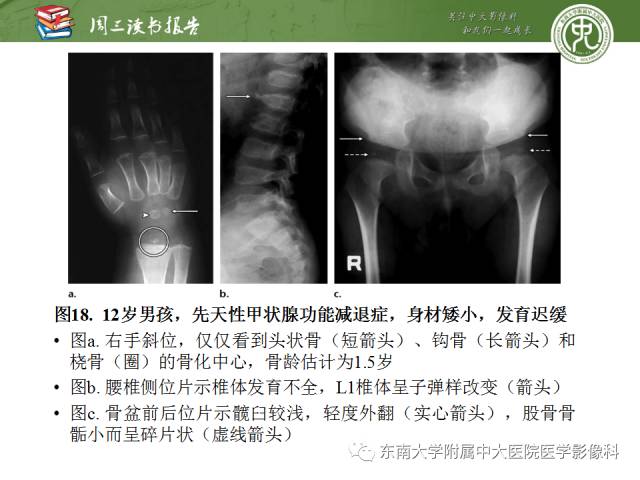 【PPT】代谢性骨病影像学表现【RG精选】