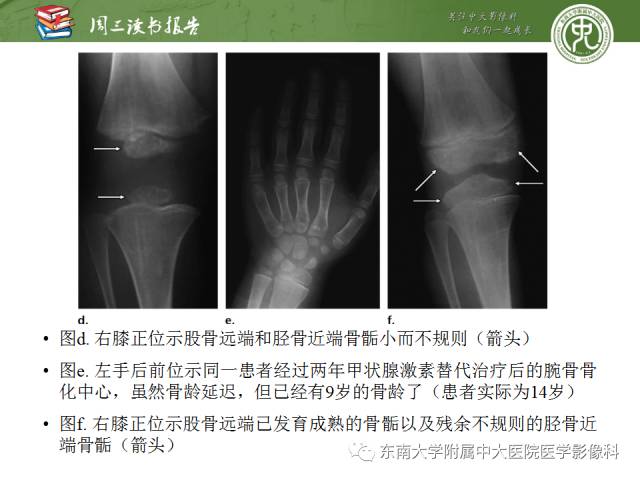 【PPT】代谢性骨病影像学表现【RG精选】