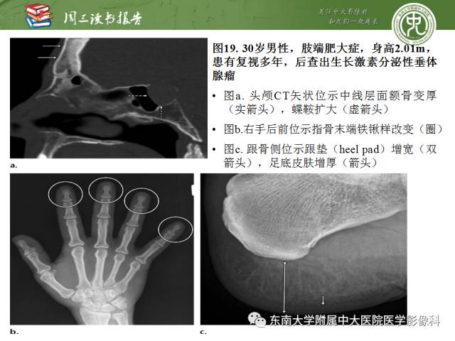 【PPT】代谢性骨病影像学表现【RG精选】