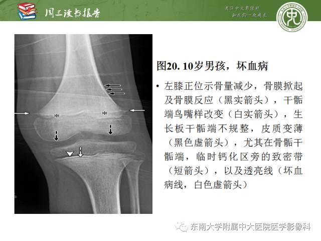 【PPT】代谢性骨病影像学表现【RG精选】