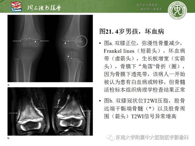 【PPT】代谢性骨病影像学表现【RG精选】