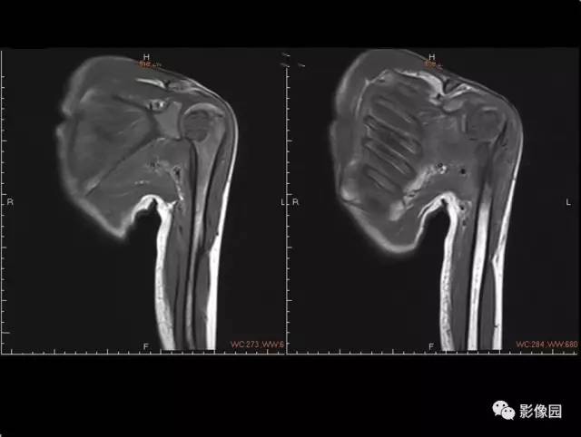 【病例】左侧肱骨软骨母细胞瘤1例X线CT及MR影像表现 【病例】左侧肱骨软骨母细胞瘤1例X线CT及MR影像表现