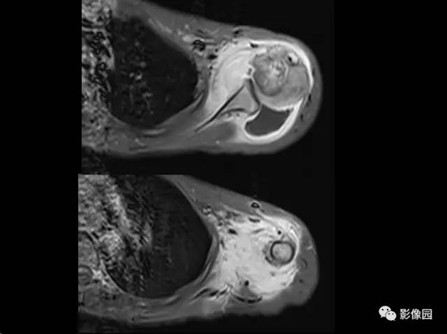 【病例】左侧肱骨软骨母细胞瘤1例X线CT及MR影像表现 【病例】左侧肱骨软骨母细胞瘤1例X线CT及MR影像表现
