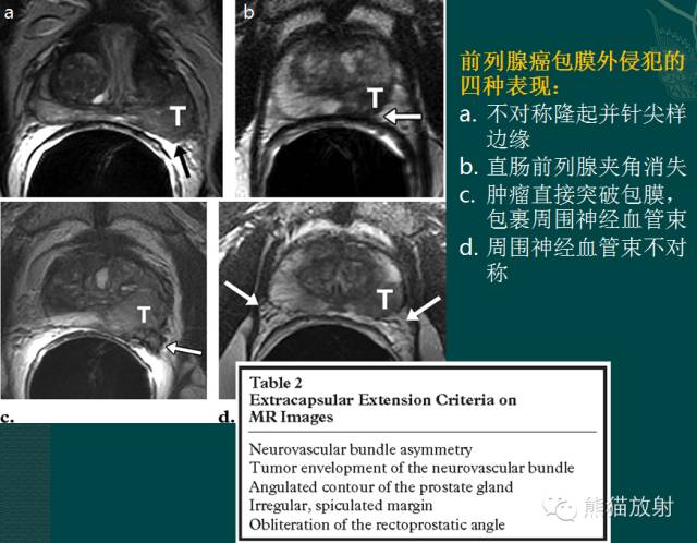 前列腺癌MRI诊断与鉴别诊断 前列腺癌MRI诊断与鉴别诊断