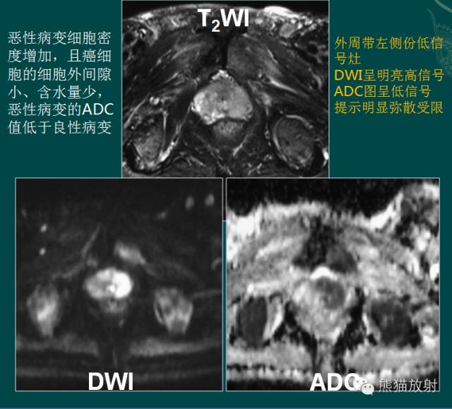 前列腺癌MRI诊断与鉴别诊断 前列腺癌MRI诊断与鉴别诊断