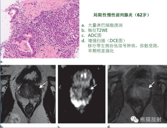 前列腺癌MRI诊断与鉴别诊断 前列腺癌MRI诊断与鉴别诊断