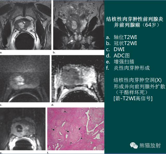 前列腺癌MRI诊断与鉴别诊断 前列腺癌MRI诊断与鉴别诊断