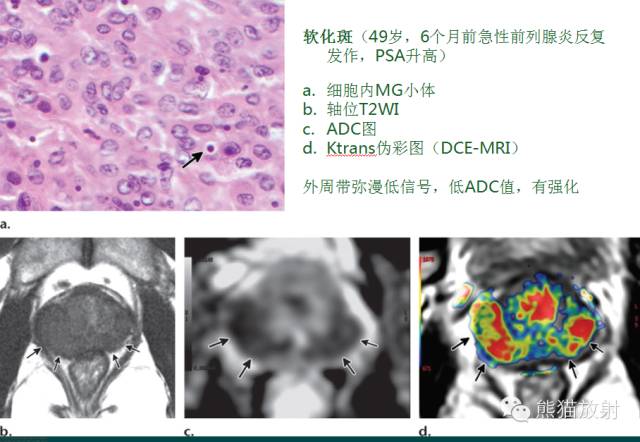 前列腺癌MRI诊断与鉴别诊断 前列腺癌MRI诊断与鉴别诊断