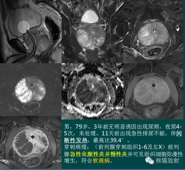 前列腺癌MRI诊断与鉴别诊断 前列腺癌MRI诊断与鉴别诊断