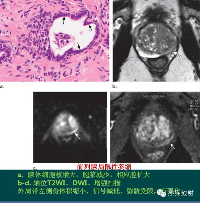 前列腺癌MRI诊断与鉴别诊断 前列腺癌MRI诊断与鉴别诊断