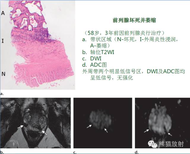 前列腺癌MRI诊断与鉴别诊断 前列腺癌MRI诊断与鉴别诊断
