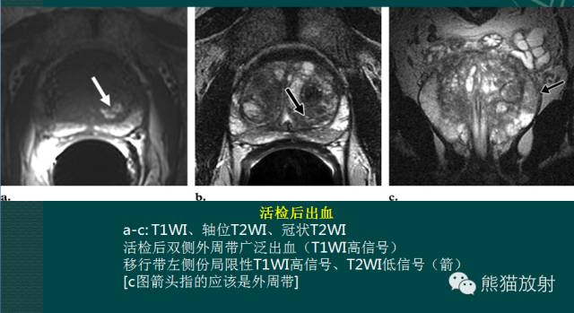 前列腺癌MRI诊断与鉴别诊断 前列腺癌MRI诊断与鉴别诊断