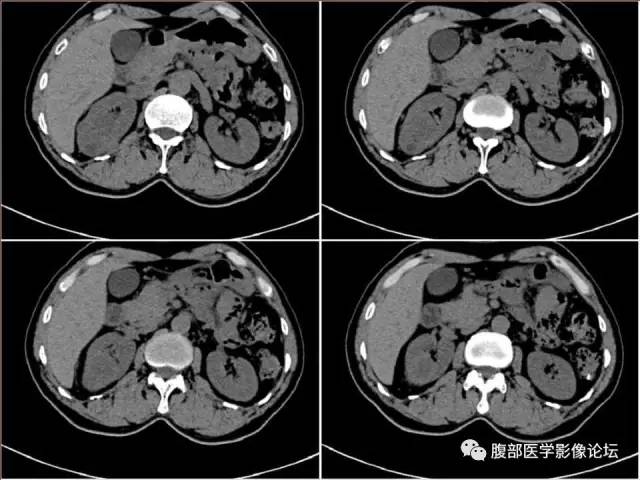 【病例】右肾癌(透明细胞肾癌)1例CT及MR影像表现