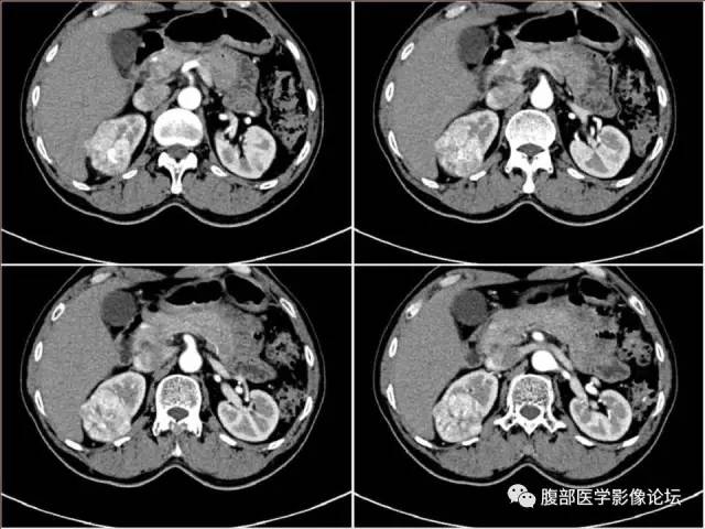 【病例】右肾癌(透明细胞肾癌)1例CT及MR影像表现