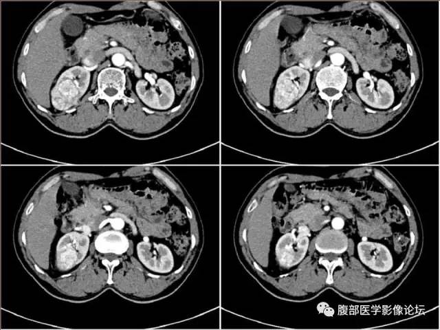 【病例】右肾癌(透明细胞肾癌)1例CT及MR影像表现