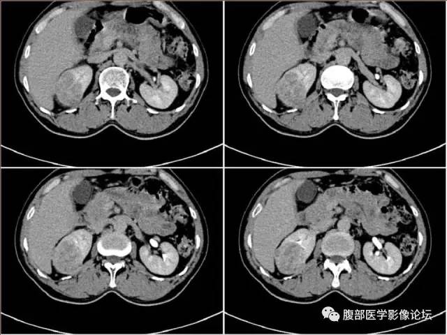 【病例】右肾癌(透明细胞肾癌)1例CT及MR影像表现