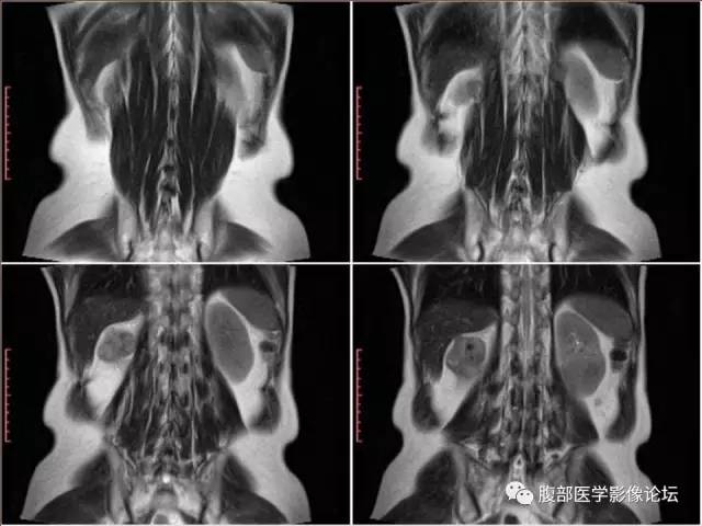 【病例】右肾癌(透明细胞肾癌)1例CT及MR影像表现