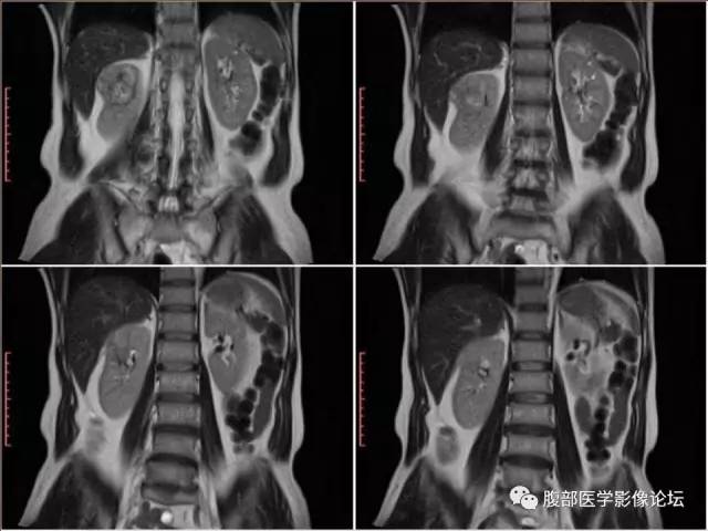 【病例】右肾癌(透明细胞肾癌)1例CT及MR影像表现