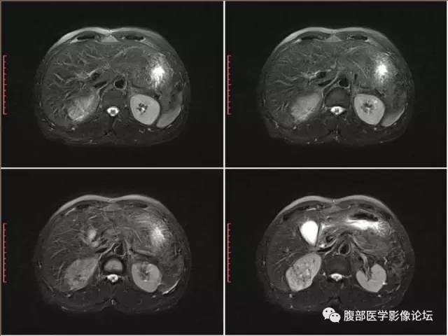 【病例】右肾癌(透明细胞肾癌)1例CT及MR影像表现