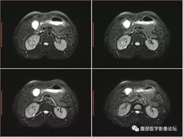 【病例】右肾癌(透明细胞肾癌)1例CT及MR影像表现