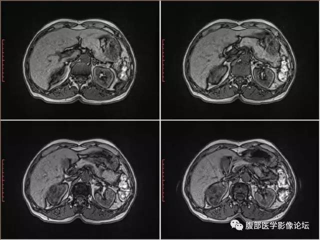 【病例】右肾癌(透明细胞肾癌)1例CT及MR影像表现