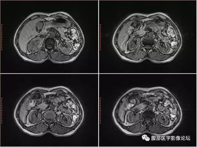 【病例】右肾癌(透明细胞肾癌)1例CT及MR影像表现