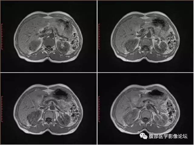 【病例】右肾癌(透明细胞肾癌)1例CT及MR影像表现