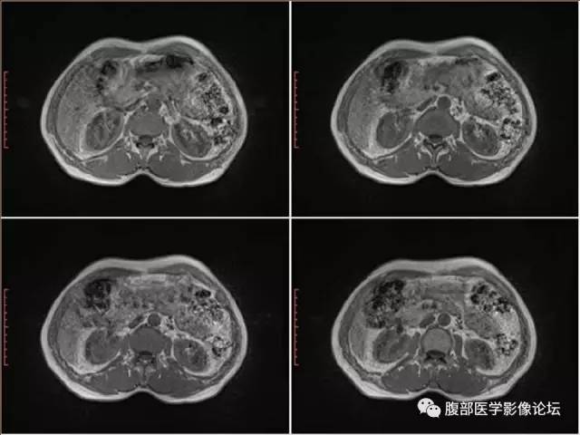 【病例】右肾癌(透明细胞肾癌)1例CT及MR影像表现