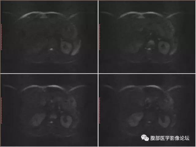 【病例】右肾癌(透明细胞肾癌)1例CT及MR影像表现