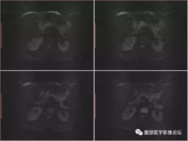 【病例】右肾癌(透明细胞肾癌)1例CT及MR影像表现