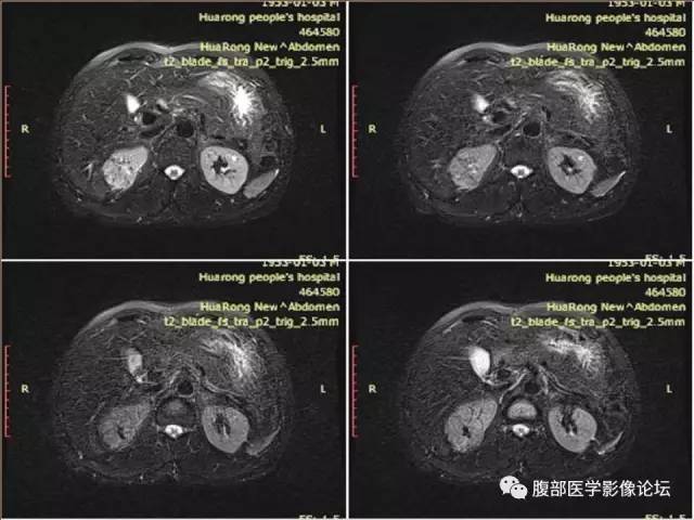 【病例】右肾癌(透明细胞肾癌)1例CT及MR影像表现