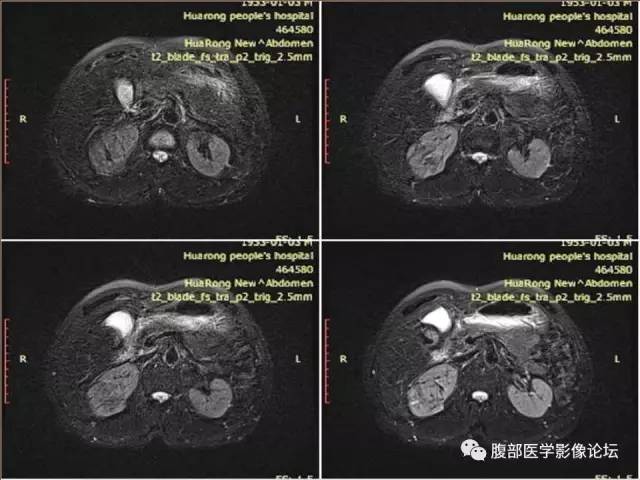 【病例】右肾癌(透明细胞肾癌)1例CT及MR影像表现
