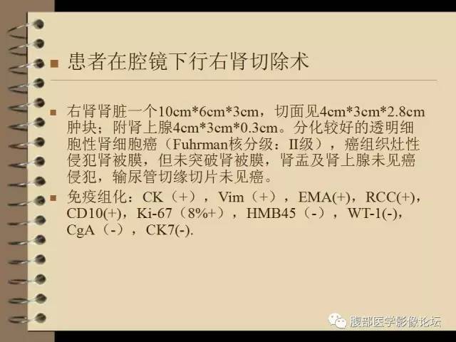 【病例】右肾癌(透明细胞肾癌)1例CT及MR影像表现