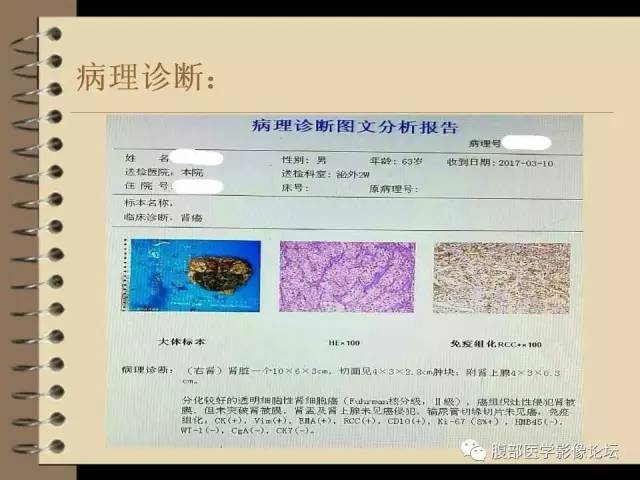 【病例】右肾癌(透明细胞肾癌)1例CT及MR影像表现