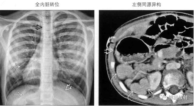 kartagener综合征、内脏异位综合征 kartagener综合征、内脏异位综合征