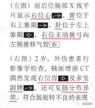 kartagener综合征、内脏异位综合征 kartagener综合征、内脏异位综合征
